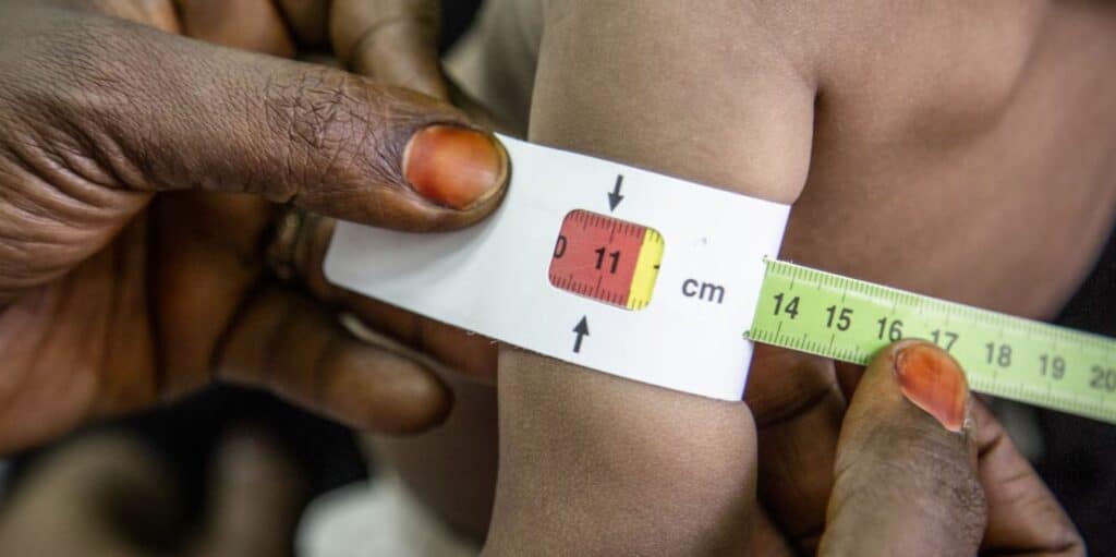 Måling av omkrets på en barnearm som viser at barnet er under ernært